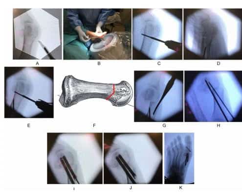 Cirurgia Minimamente invasiva - MIS