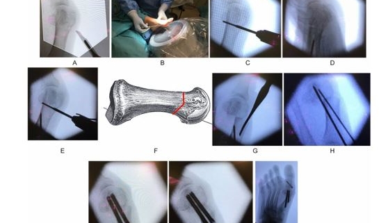 Cirurgia Minimamente Invasiva Mis Dr Fabio Datti Ortopedista