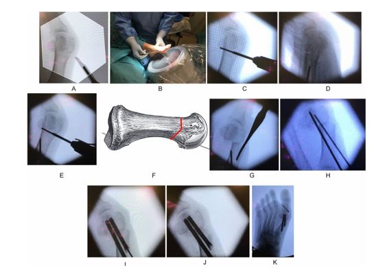 Cirurgia Minimamente Invasiva Mis Dr Fabio Datti Ortopedista Especialista Em P E Tornozelo