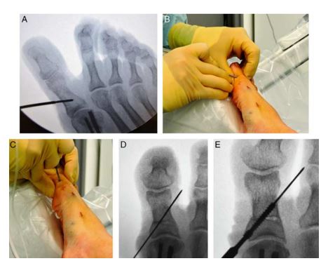 Cirurgia Minimamente Invasiva Mis Dr Fabio Datti Ortopedista Especialista Em P E Tornozelo